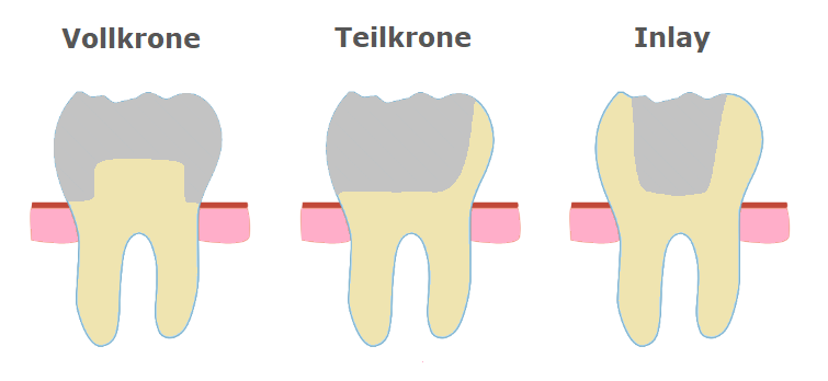 Zahnkrone, Teilkrone 